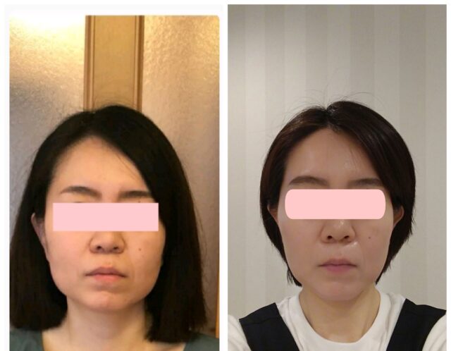 小顔矯正、増えてます